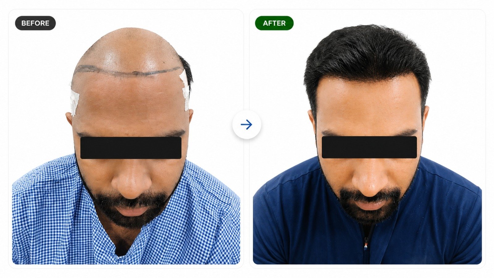 Hair Transplant Before and After - Patient 7